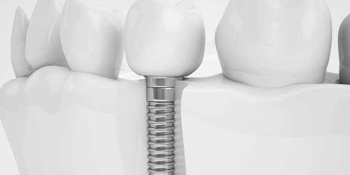 Resolving Temporomandibular Joint Problems with Dental Implants and Bleaching in Hamburg