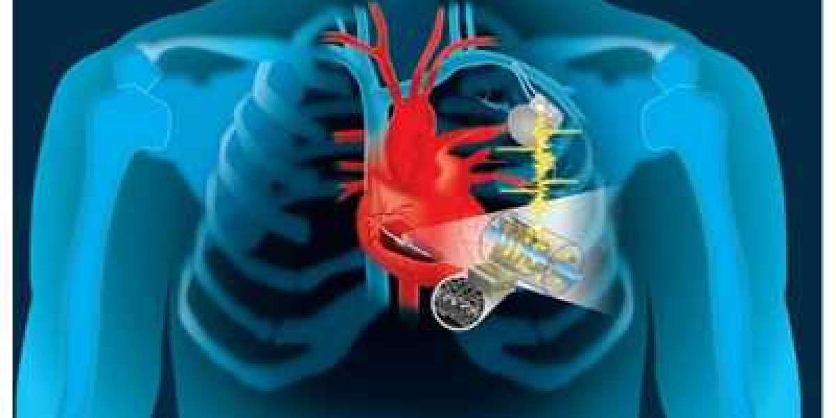 Structural Heart Devices Market Soars $22.64 Billion by 2030