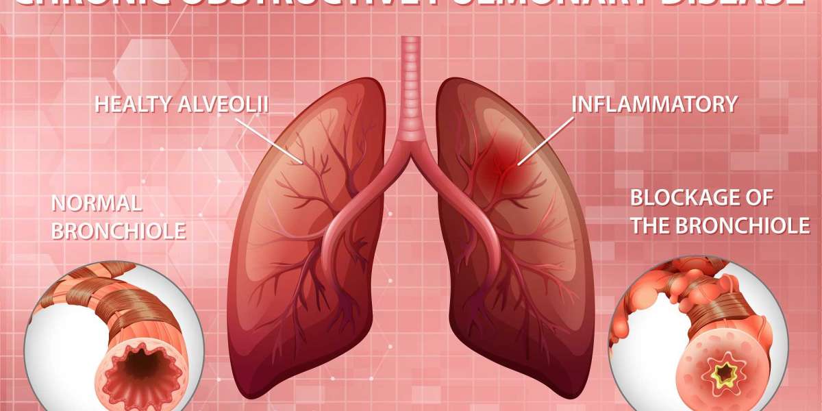 Chronic Obstructive Pulmonary Disease Market Players to Make Significant Progress During the Forecast Period