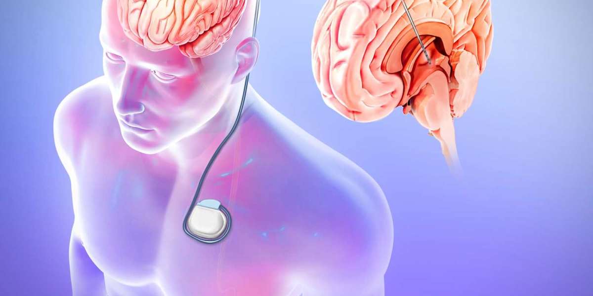 Global Epilepsy Surgery Market Players Share Growth, and Trends by 2030