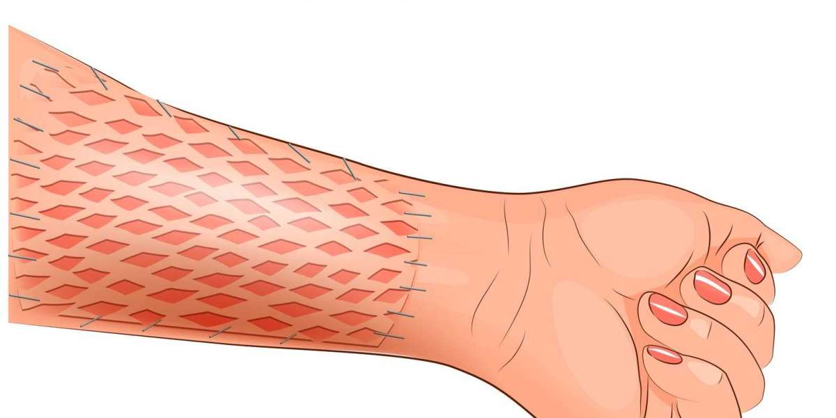 A Comprehensive Research of the Global Skin Graft Market Players