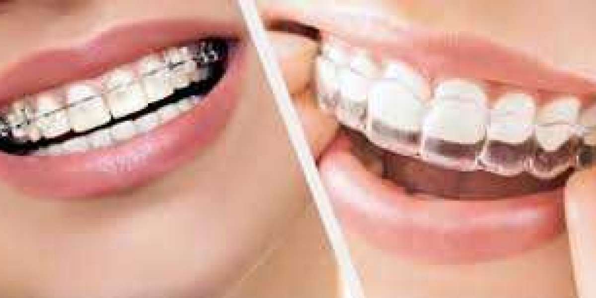 All About Affordable Dental Implant Solutions In India