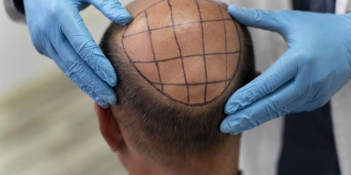 Palm Desert's FUT Hair Transplant Experts