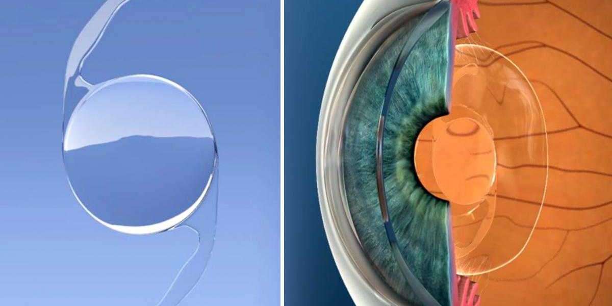 Cataract Surgery Revolution: Intraocular Lens Market Poised for Growth at 5.72% CAGR