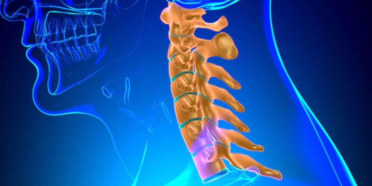 Beyond Fusion: Artificial Disc Replacement Offers Hope for Active Back Pain Sufferers
