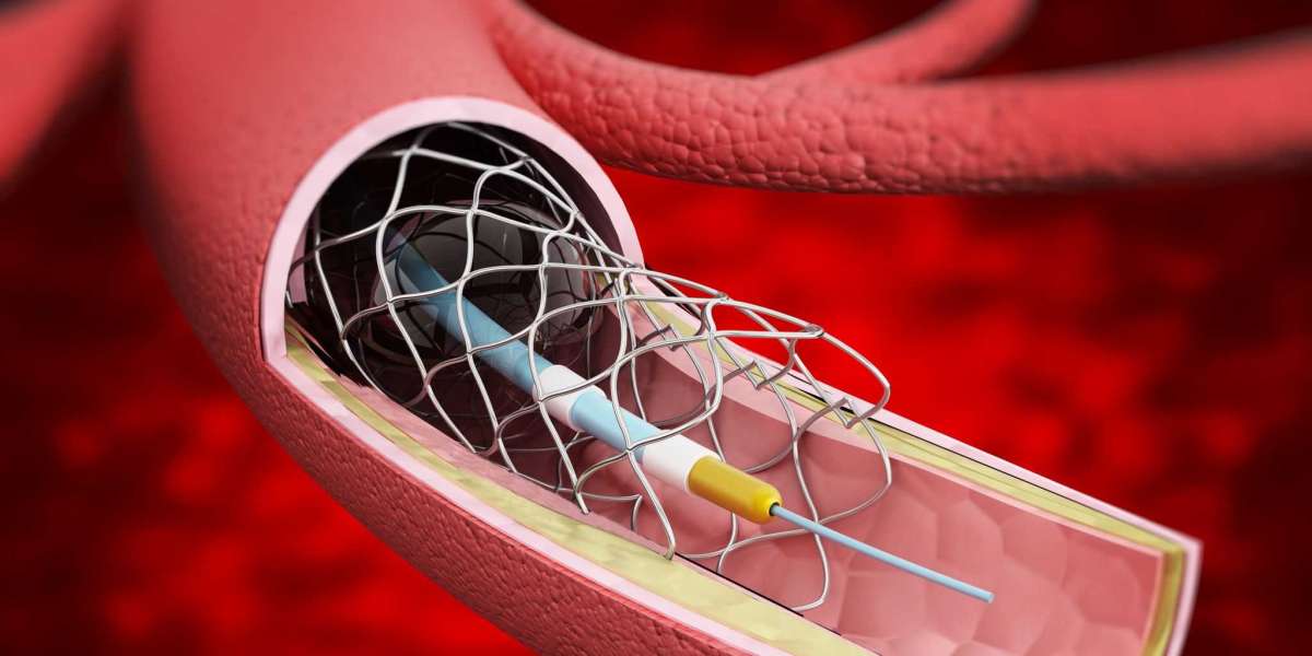 Beyond Bypass: Stents Offer a Minimally Invasive Approach to Clear Blocked Arteries
