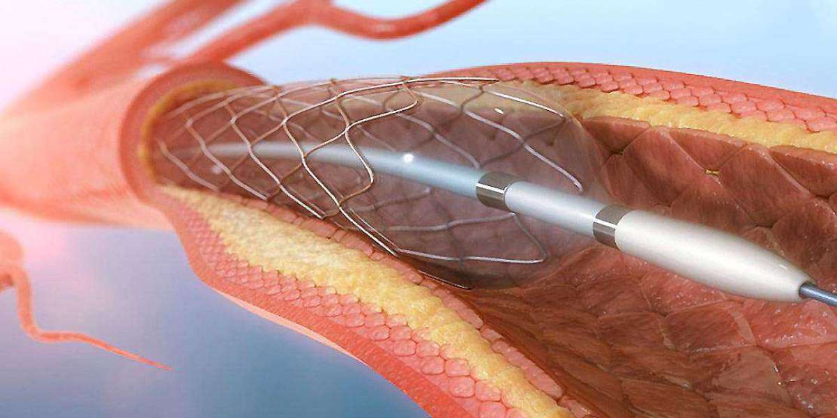Neurointervention Drives Innovation in the Growing Cerebral Vascular Stent Market