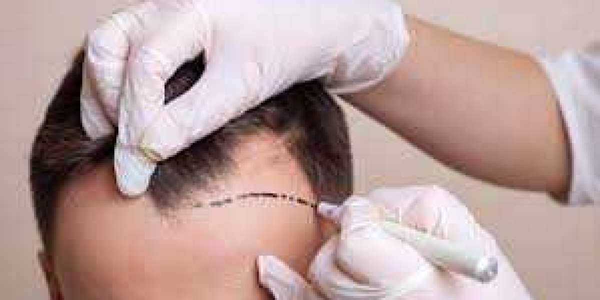 Explore Hair Restoration Options in London with Us