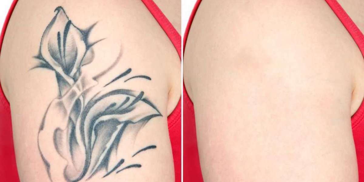 A Fresh Start: Laser Tattoo Removal Offers Effective and Safe Solutions