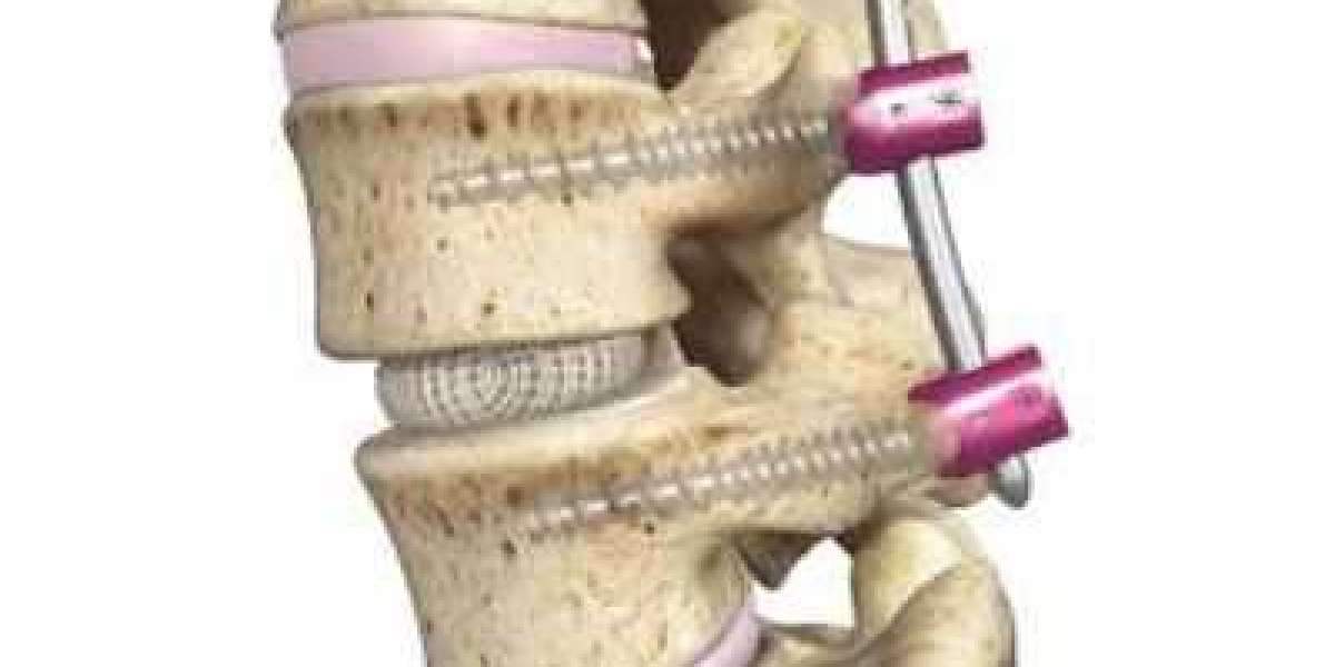 Spinal Interbody Fusion Market Worth $9.22 Billion by 2032