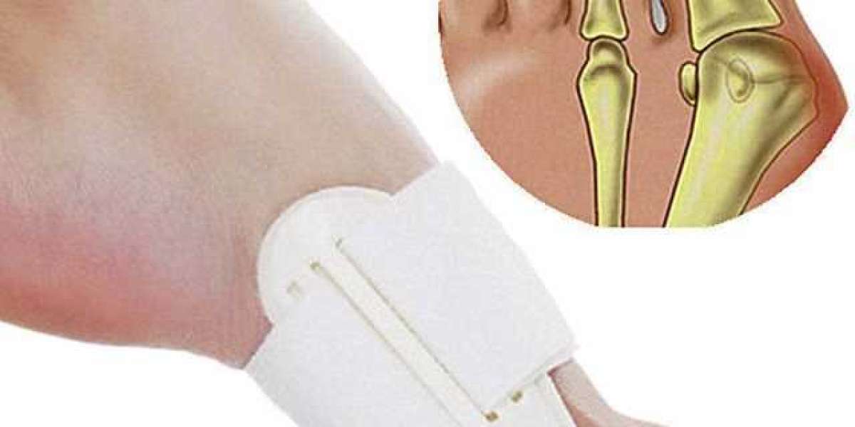 Relieve Bunion Pain with Advanced Correctors Today