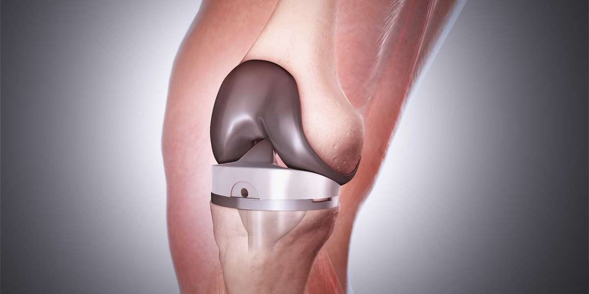 Knee Cartilage Replacement Market Trends, Size, Segment and Industry Growth by Forecast to 2031